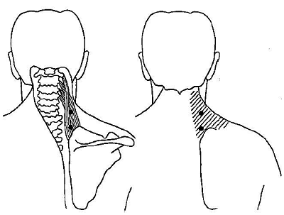 levator-scapulae-trigger-point-referred-pain