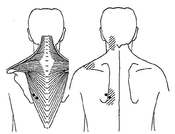 ascending-trapezius-trigger-point-and-referred-pain-pattern