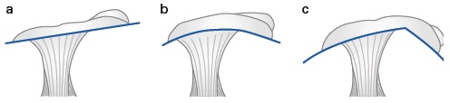 different types of acromion