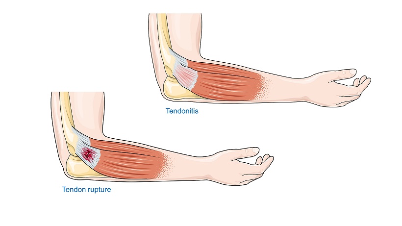 tendonitis versus tendon rupture infographic