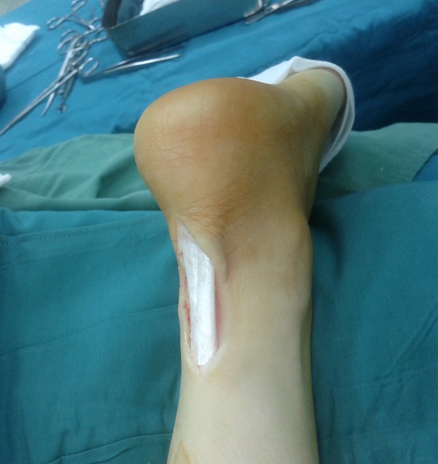 achilles tendon during surgery