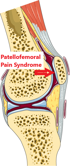 This image has an empty alt attribute; its file name is knee-patellofemoral-pain-syndrome.png