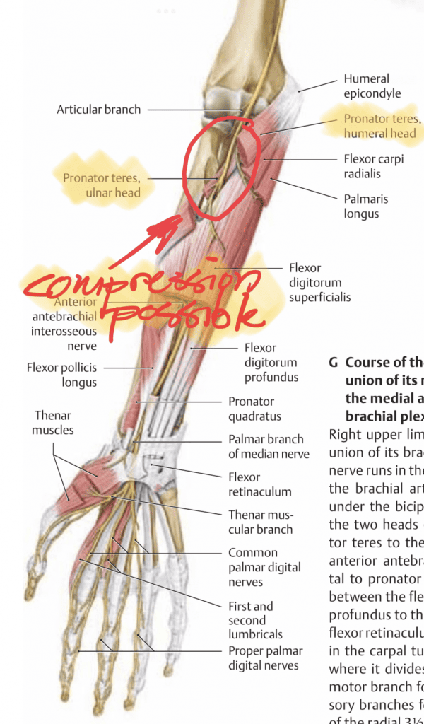 potential compression site of median nerve passing through pronator teres