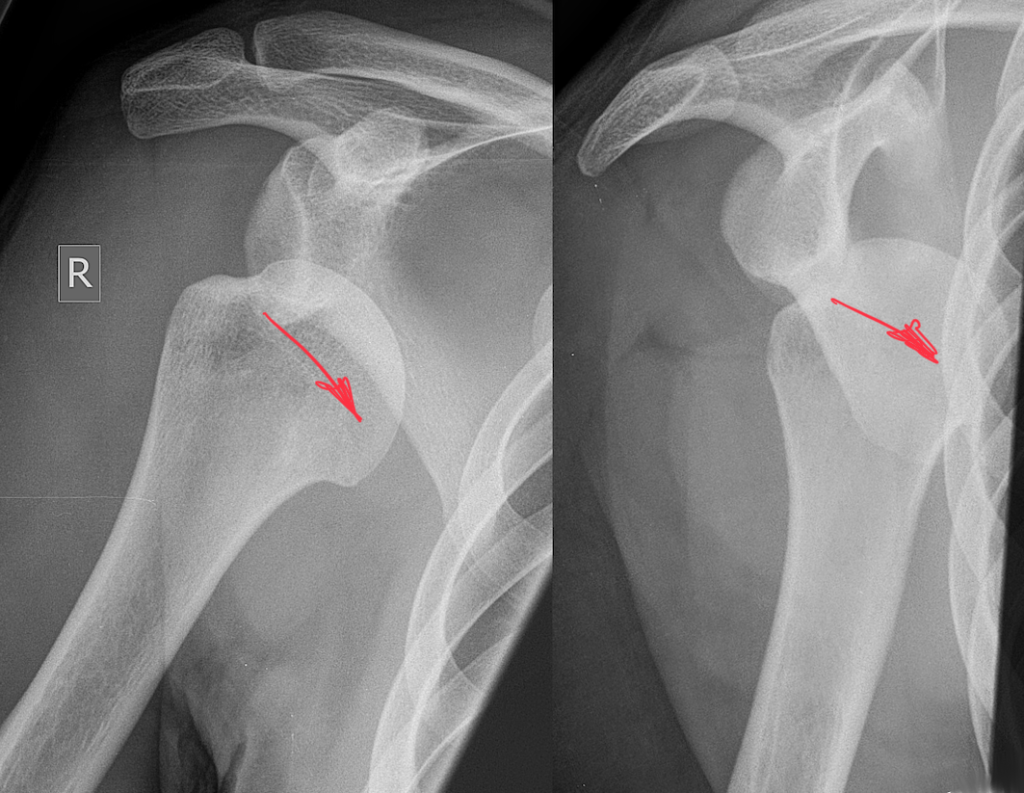 x-ray of anterior shoulder dislocation