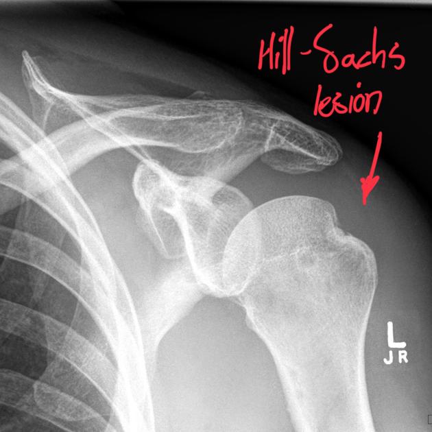 Hill-Sachs lesion on röntgen image