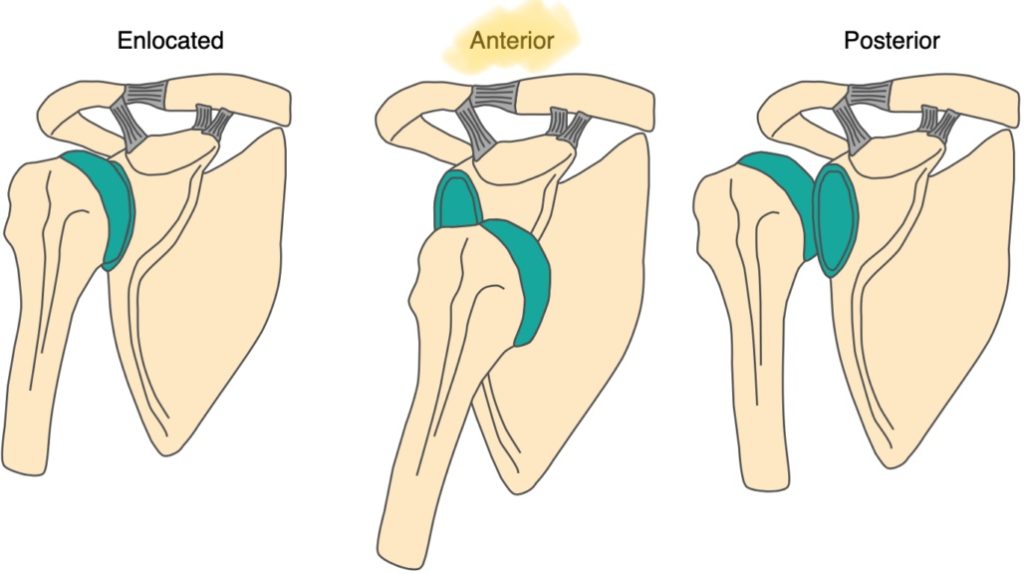 anterior and posterior shoulder dislocation