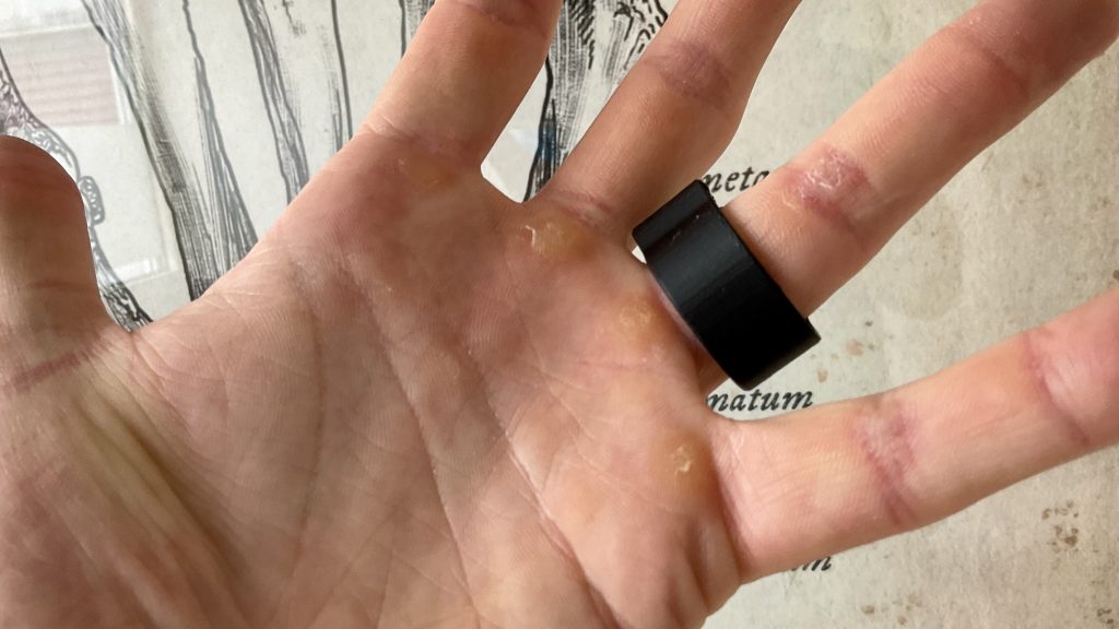 thermoplastic ring on finger