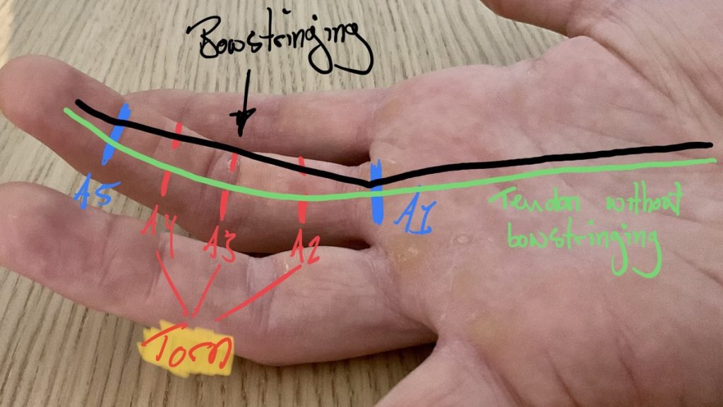infographic of bowstringing phenomenon of the flexor tendon