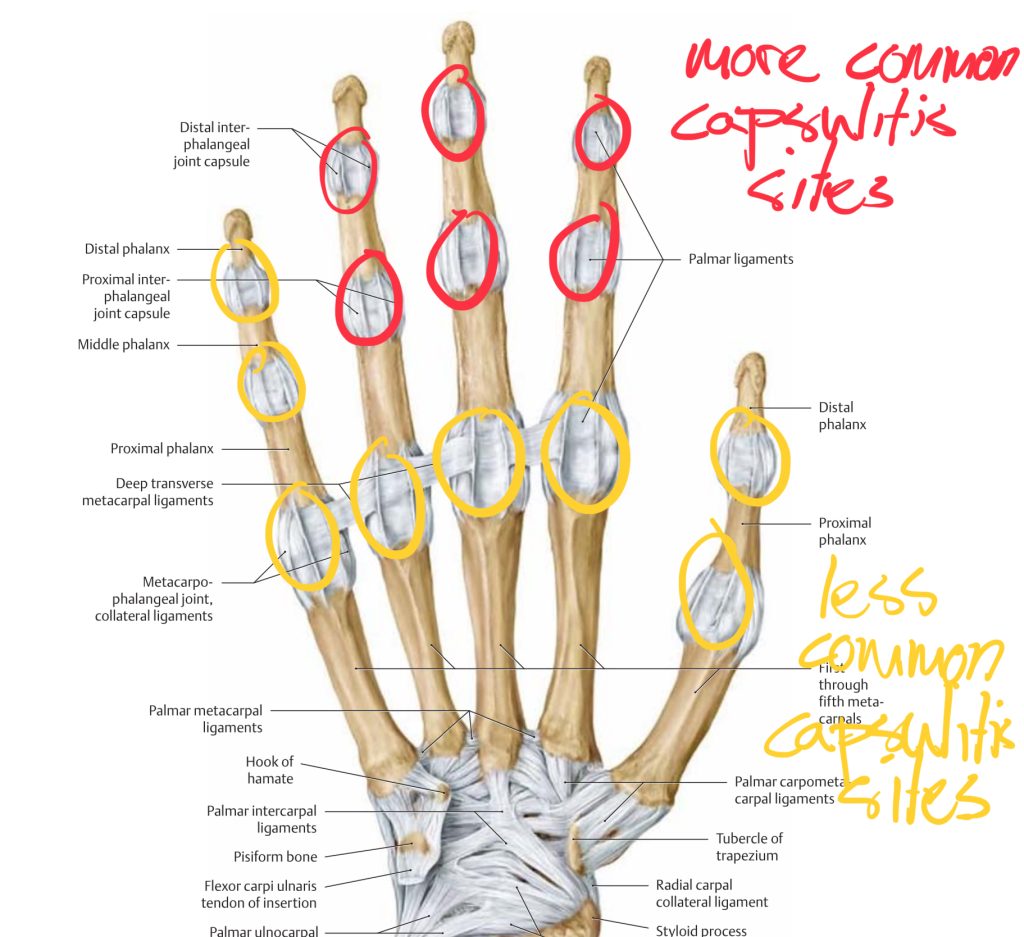 anatomy of finger with rock climbing synovitis sites